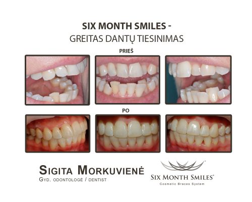 Six Month Smiles_27